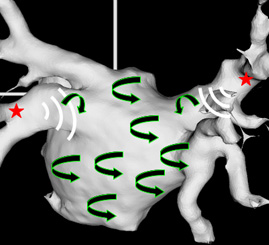 This diagram illustrates the continuous movement of fibrillating wavelets in the auricles of the heart. 