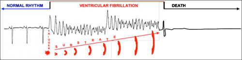 Fibrillation Ventriculaire conduisant en quelques minutes à la mort du sujet